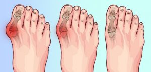 8 cách xoa dịu đau nhức do biến dạng ngón chân cái